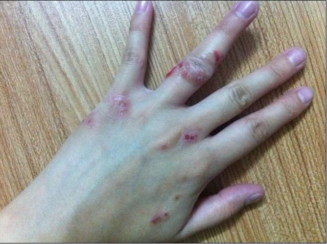 皮炎的预防方法都有哪些